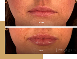 Before and After Dermal Fillers - Non-surgical Cosmetic Procedure Chicago - Impressions Face + Body